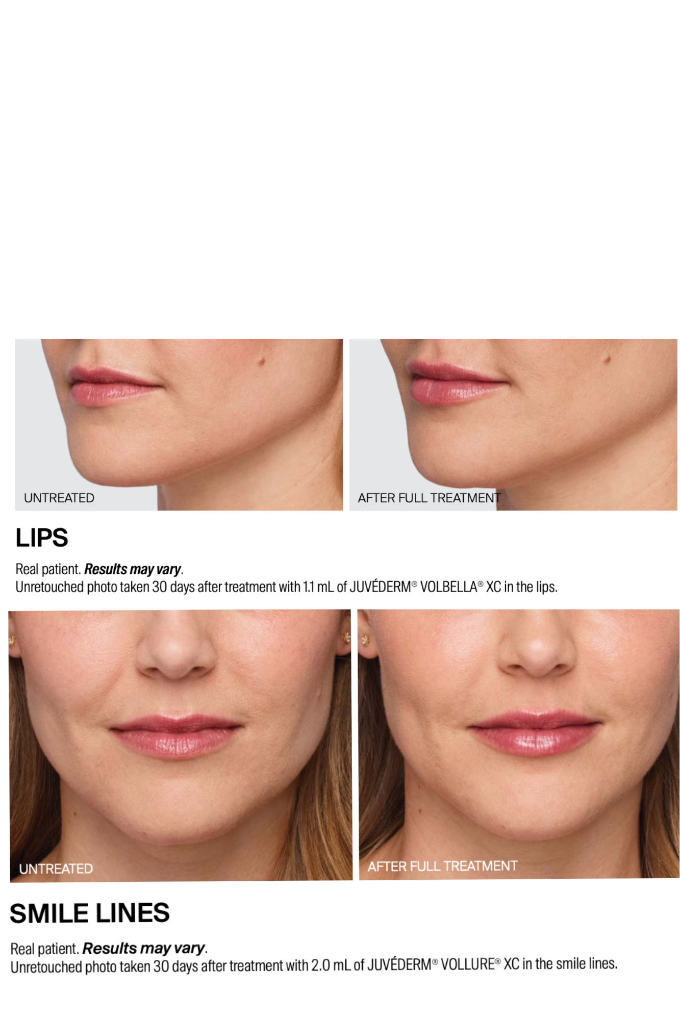 Before and after filler treatments showing enhanced lip volume and reduced smile lines