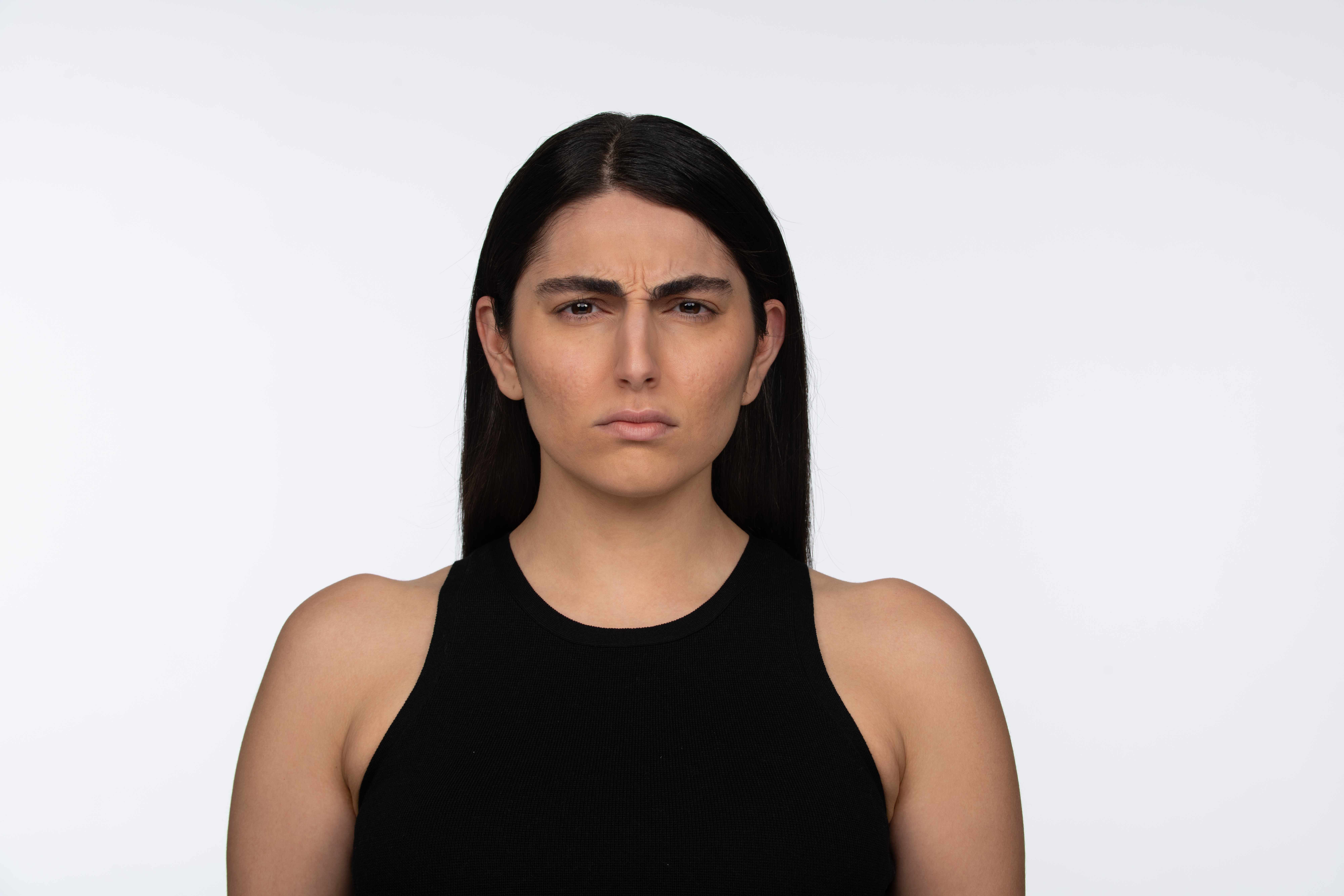 Before Jeuveau treatment showing visible frown lines and forehead wrinkles - Female patient